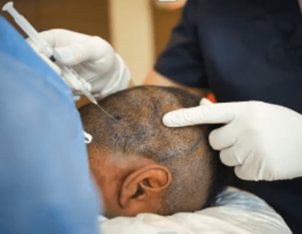 Hair Transplant Process And Cost In Kenya